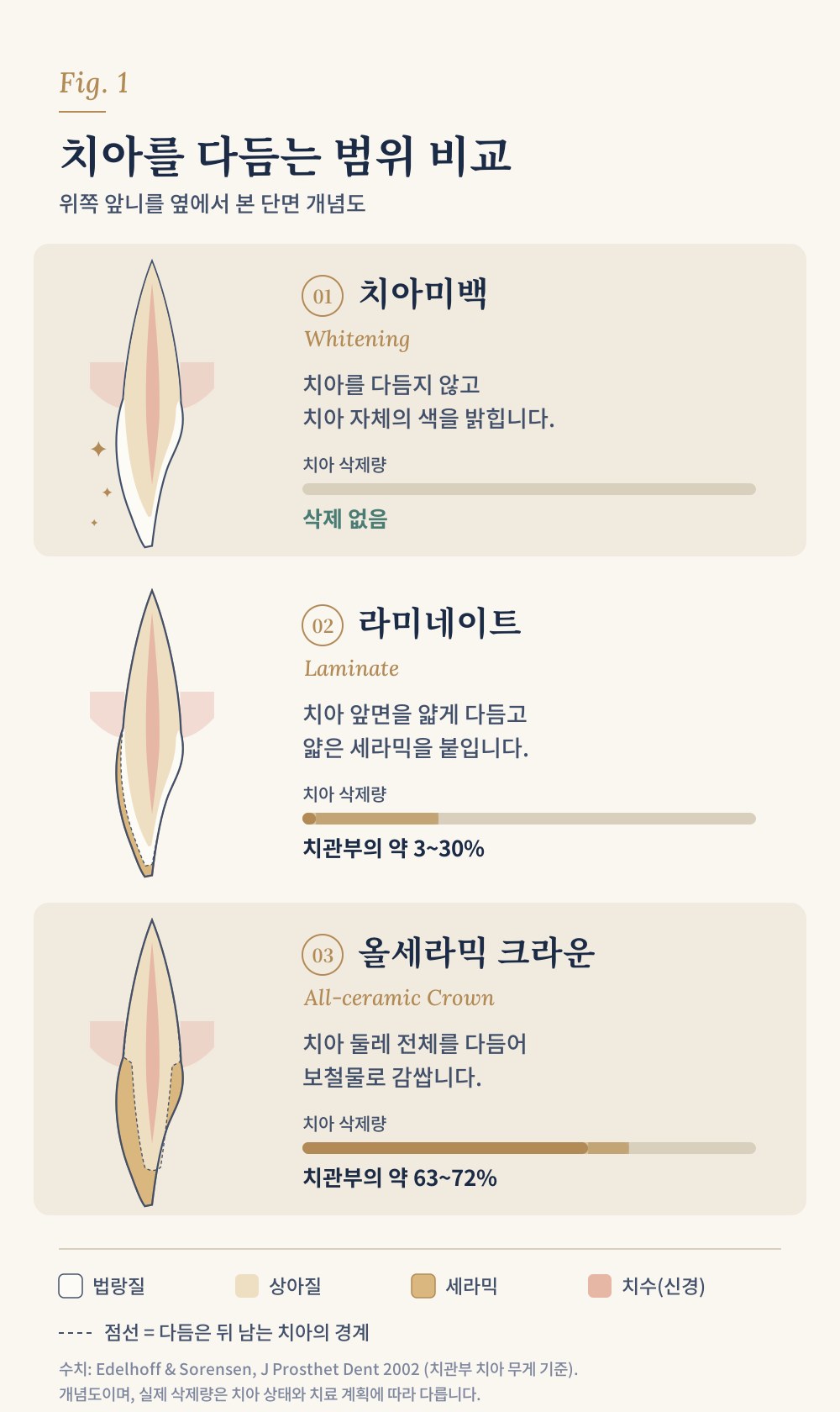 치아미백, 라미네이트, 올세라믹 크라운의 치아 삭제 범위 비교 개념도 — 삭제 없음, 치관부 약 3~30%, 약 63~72%