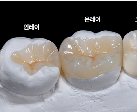 서울김앤장치과 인레이