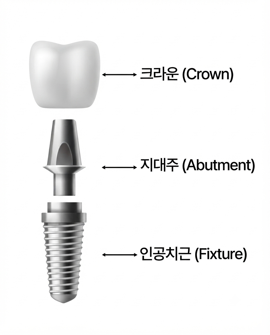 서울김앤장치과 임플란트 치과 선택 시 확인 기준
